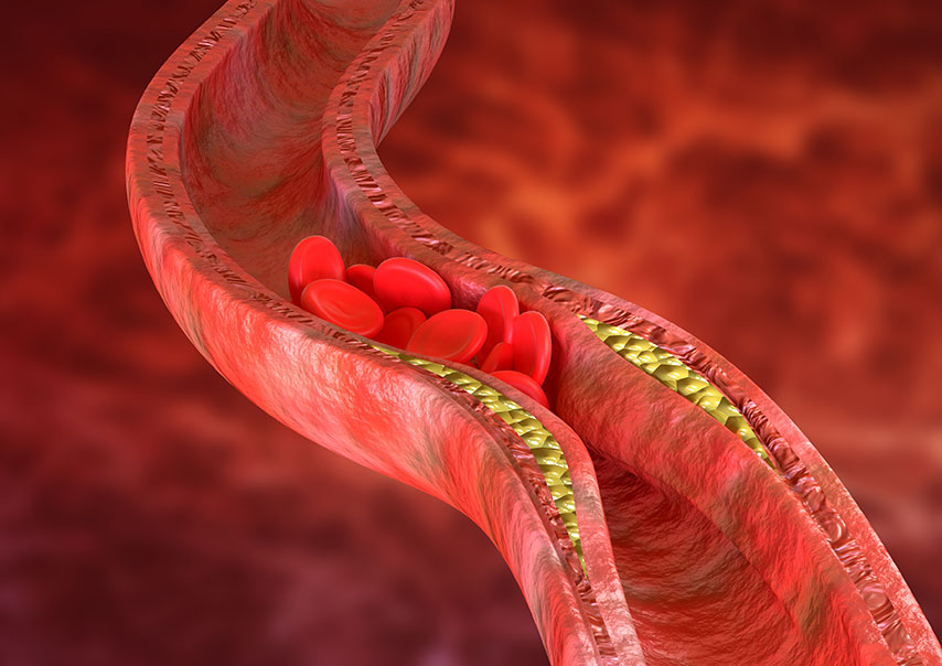 accumulation of cholesterol plaques in the artery